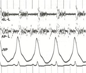 Phonocardiogram.jpg