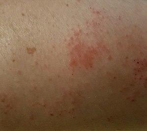Nummular dermatitits.jpg