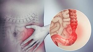 Irritable bowel syndrome.jpg