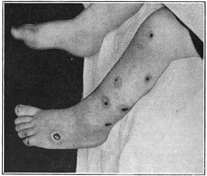 An introduction to dermatology (1905) ecthyma.jpg