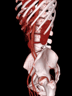 Volume rendered CT scan of abdominal and pelvic blood vessels (smaller).gif