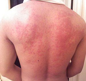 Hives on back.jpg