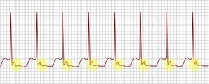 AV nodal reentrant tachycardia.png