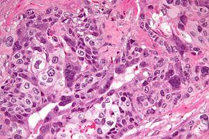 Choriocarcinoma -2- very high mag.jpg