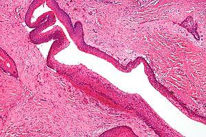 Keratocystic odontogenic tumour - intermed mag.jpg