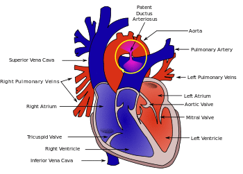 Patent ductus arteriosus.svg
