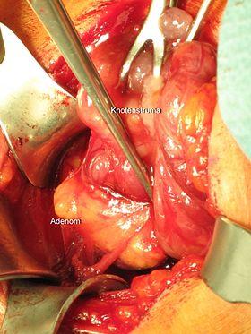 Parathyreoidea Adenom I.jpg