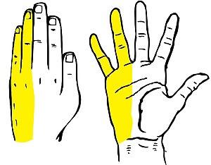 Guyon syndrome pain distribution.jpg