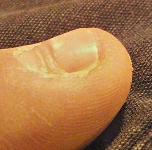 Beau's line on left, middle fingernail.jpg
