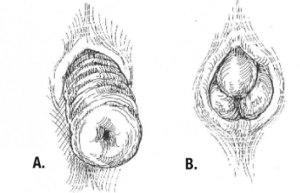 Full thickness rectal prolapse & mucosal prolapse..jpg