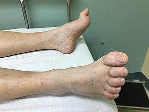Hammer toes.jpg