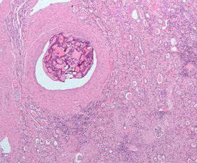 Embolization kidney.jpg