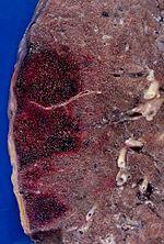 Recent hemorrhagic infarcts.jpg