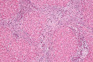 Focal nodular hyperplasia - intermed mag.jpg