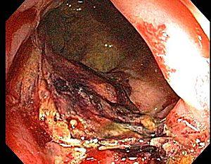 Radiation proctitis3.jpg