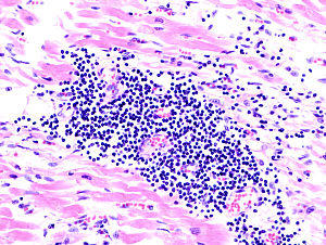 Viral myocarditis (1).JPG