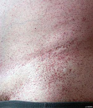 Angiokreatoma.jpg