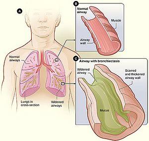 Bronchiectasis NHLBI.jpg