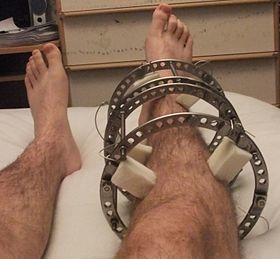 Ilizarov on right leg.jpg