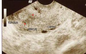 Ultrasound of Asherman's syndrome.jpg