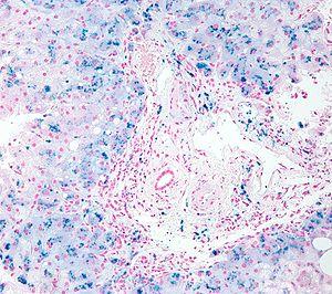 Hemosiderosis high mag.jpg