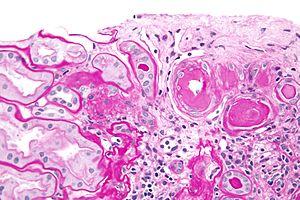 Renal arterial hyalinosis - pas - very high mag.jpg