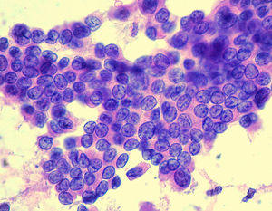 Papillary Carcinoma of the Thyroid.jpg