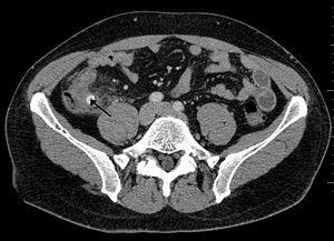 X-ray showing fecalith which has caused appendicitis.jpg
