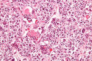 Juvenile granulosa cell tumour - very high mag.jpg