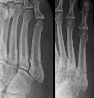 Cropped version of Jonesfracture.jpg
