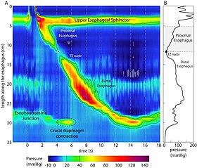 Pressure topography plot during a normal swallow, measured using a 36-channel high-resolution manometry system.jpg