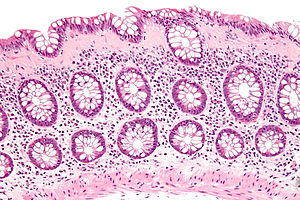 Collagenous colitis - high mag.jpg