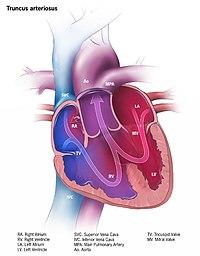 Truncus arteriosus.jpg