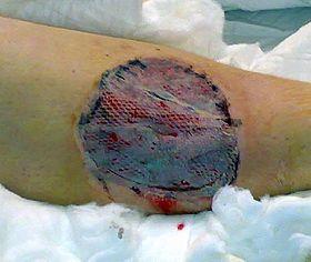 Skin graft treated with vacuum assisted closure for five days.jpg