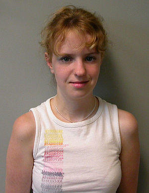 Jacobsen syndrome patient.JPG