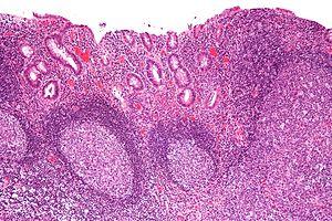 Diversion proctitis - intermed mag.jpg