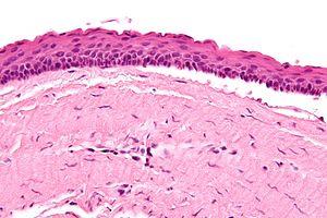 Keratocystic odontogenic tumour - 2 - very high mag.jpg
