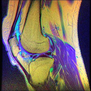 Knee MRI, T1T2PD 08.jpg