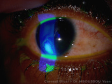 Corneal Ulcer after a bacterial keratitis