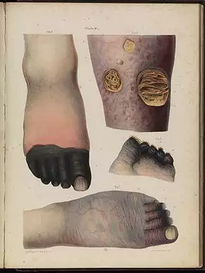 Four drawn illustrations on a page, including (top left) a foot with black toes, (top right) a limb with holes in the skin showing yellowed matter beneath, (centre right) the end of a foot with blackened stubs where the toes once were, and (bottom) a foot that is wrinkled and dark, with prominent veins and purple toes.