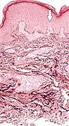 Histopathology of elastosis perforans serpiginosa.jpg