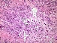 Histopathology of adenosquamous carcinoma of the pancreas.jpg