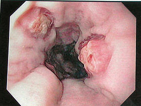 Esophageal varices - post banding.jpg