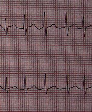 RapidAFib150 (cropped).jpg