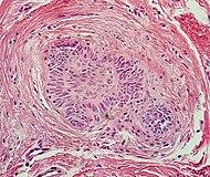 Histopathology of hair follicle periphery.jpg
