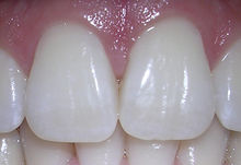 06-10-06centralincisors.jpg