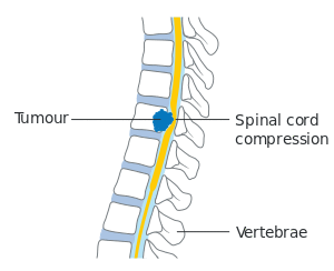 Diagram showing a tumour causing spinal cord compression CRUK 081.svg