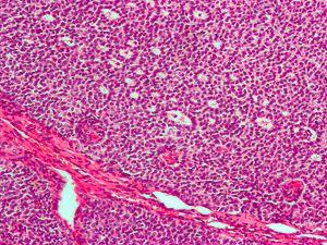 Granulosa cell tumour2.jpg