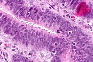 Tumour-infiltrating lymphocytes - 2 -- very high mag.jpg