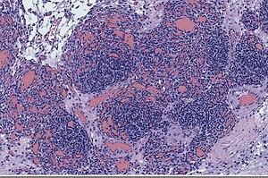 Kaposiform hemangioendothelioma.JPG